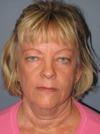 Neck Lift, Platysmaplasty before 634748