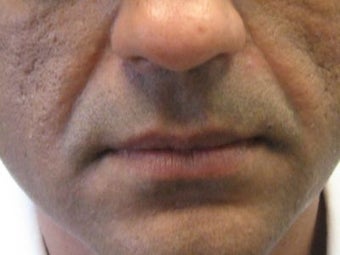 Radiesse Injections before 272053