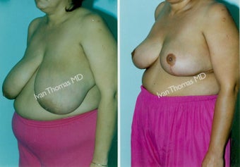 Breast Reduction before 243751