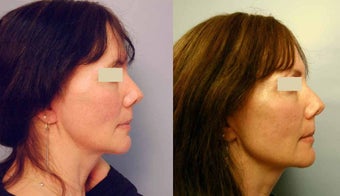 Sculptra treatments before 125340