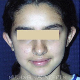 Otoplasty (ear set-back) before 147638