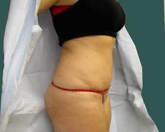 Tummy tuck 561249
