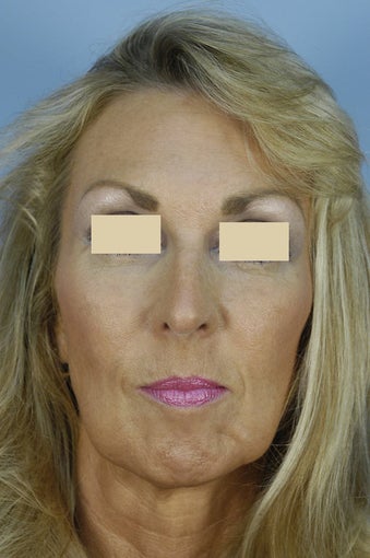 Qt Mini-Facelift with chin augmentation before 163550