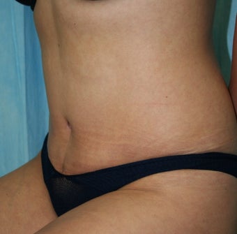 Local Anaesthetic Tummy Tuck 344435