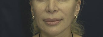 Lip Lift after 606645