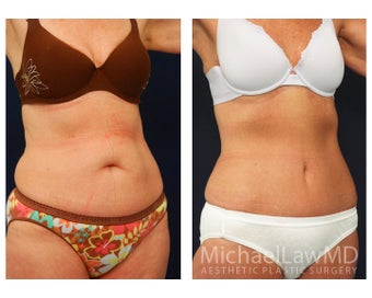 Abdominoplasty - Tummy Tuck after 396080