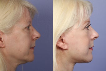Eyelid Surgery before 301864