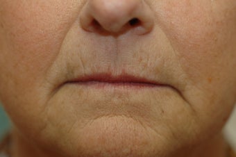 Hetter facial resurfacing before 434878