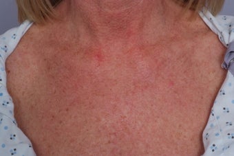 Laser treatment to Chest after 253107