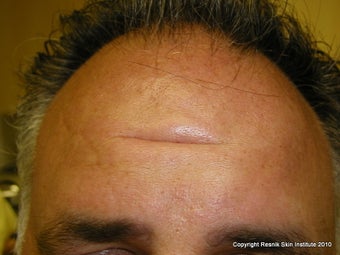 Forehead scar revision with simple excision before 252793