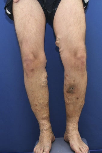 vnus ablation before 297051