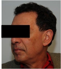Dysport treatment for Crow's Feet after 123620