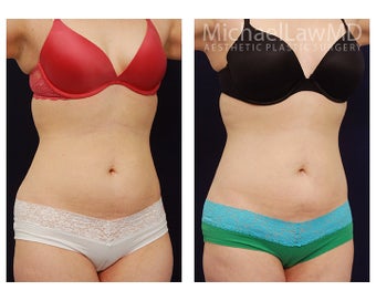 Liposuction after 391813