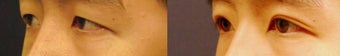 Asian Eyelid Surgery before 390265