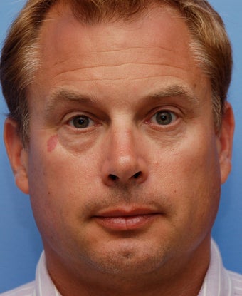 Cheek Dermafiller, Under Eye Dermafiller before 217102