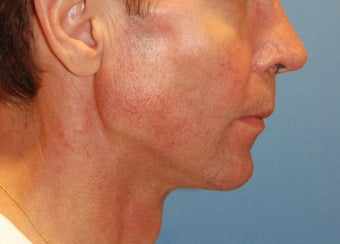 Jaw Augmentation with Mandibular Implants after 166199