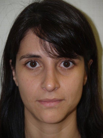 Rhinoplasty after 309561