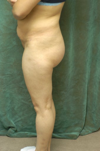 Women's Buttocks Augmentation after 518113