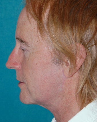 Facelift, brow and eyelid lifts after 118267