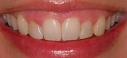 Botox for a gummy smile 371663