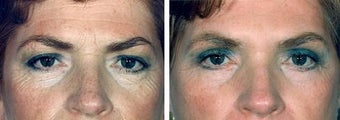Forehead Lift before 652133