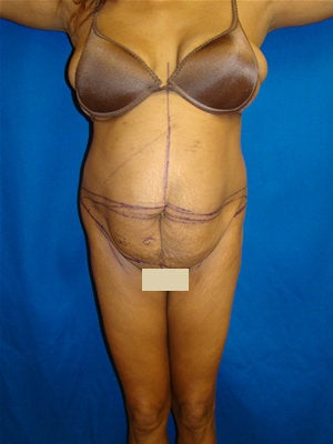 Tummy Tuck Surgery (abdominoplasty) before 133649