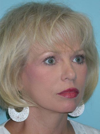 Full Facial Rejuvenation after 148574