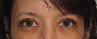 Upper Blepharoplasty after 125923