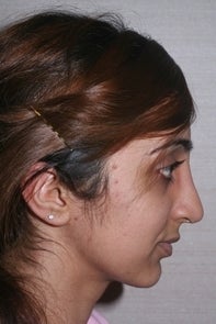 Asian Rhinoplasty 448659