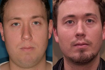Chin Augmentation after 409093