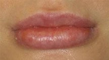 Lip Surgery, Lip Reduction before 458982