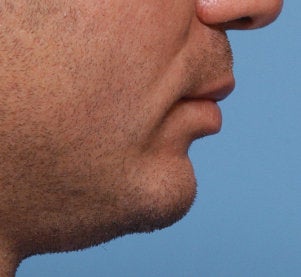 Chin Augmentation 521701