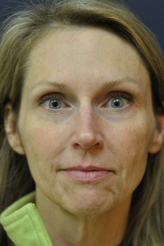 Botox after 622160