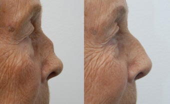 Rhinoplasty before 225885