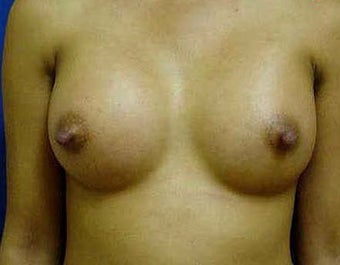 Breast Augmentation after 317789