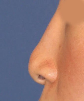 Revision Rhinoplasty 410604