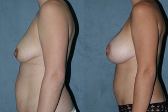 Breast Augmentation - Silicone Implants after 130838