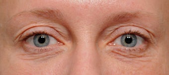 Blepharoplasty before 521700