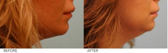 Lip Reduction before 245416