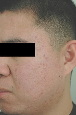 Laser Acne Scar Removal after 86374