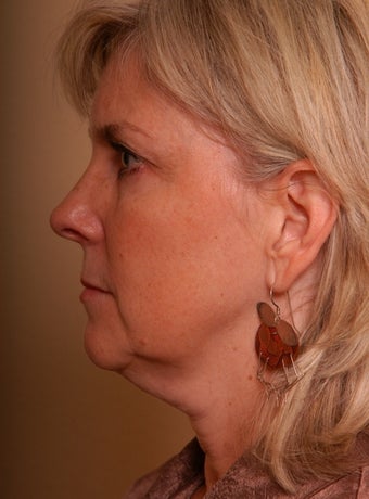 Refresher Facelift w/Neck Plication, Browllift, Fat Injections to Cheeks before 252876