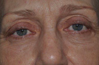 Bilateral upper and lower blepharoplasty, and 4 lid permanent eyeliner before 277496