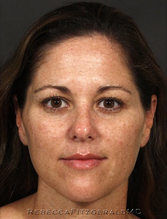 Restylane, Botox, Obagi Skin Care before 319351