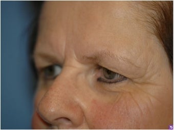 Pretrichial forehead lift and upper blepharoplasty 377313