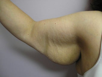 Arm Lift before 389008