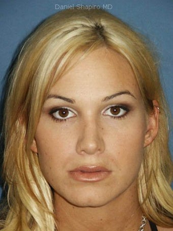 Rhinoplasty with sculpting of nasal tip and nasal dorsum after 249023