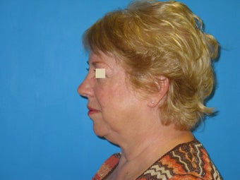 Facelift before 147385