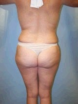 Tummy Tuck (Abdominoplasty), Breast Augmentation, Mommy Makeover 394820