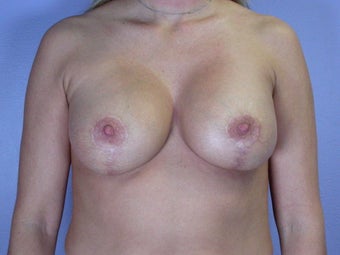 Breast Lift / Breast Augmentation after 290962