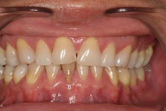 Porcelain Veneers before 213075